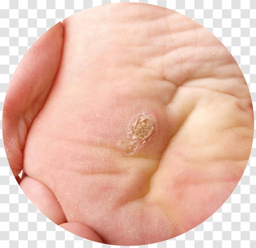 Plantar Wart Callus Foot Dermatology - Frame - Corn Transparent PNG