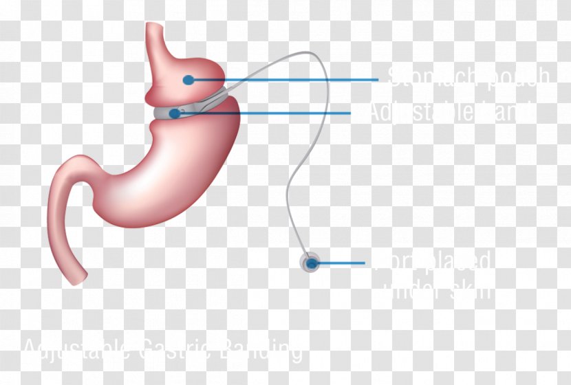 Bariatric Surgery Adjustable Gastric Band Bypass Sleeve Gastrectomy - Heart Transparent PNG