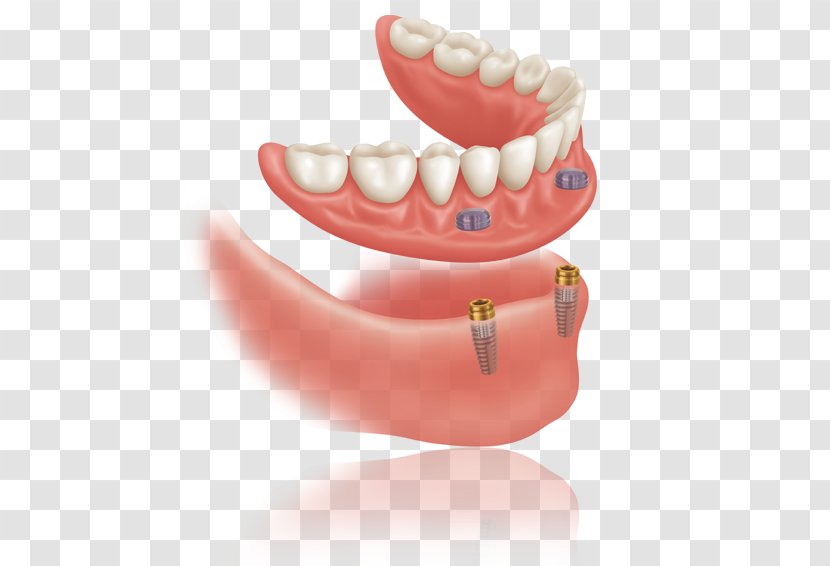 Dentures Dental Implant Bridge Bars Dentistry - Lip Transparent PNG