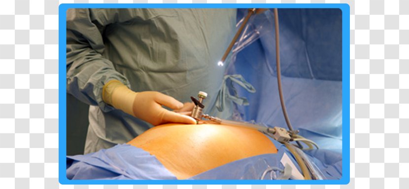 Laparoscopy Colorectal Surgery General Surgeon - Hysterectomy Transparent PNG