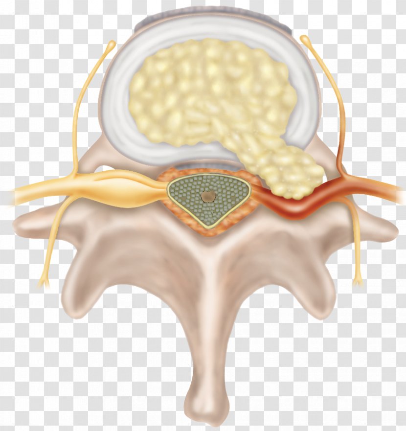 Spinal Disc Herniation Vertebral Column Intervertebral Cervical Vertebrae Nerve Root - Heart - Lining Transparent PNG