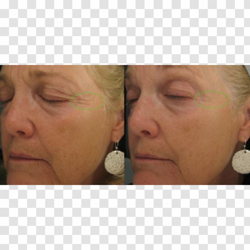 Cheek Wrinkle Anti-aging Cream Rhytidectomy Face - Skin Transparent PNG