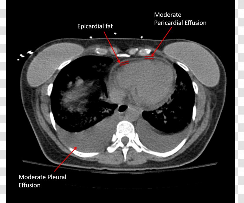 Computed Tomography Pericardial Effusion Pericardium Pericardiectomy Pericarditis Transparent PNG