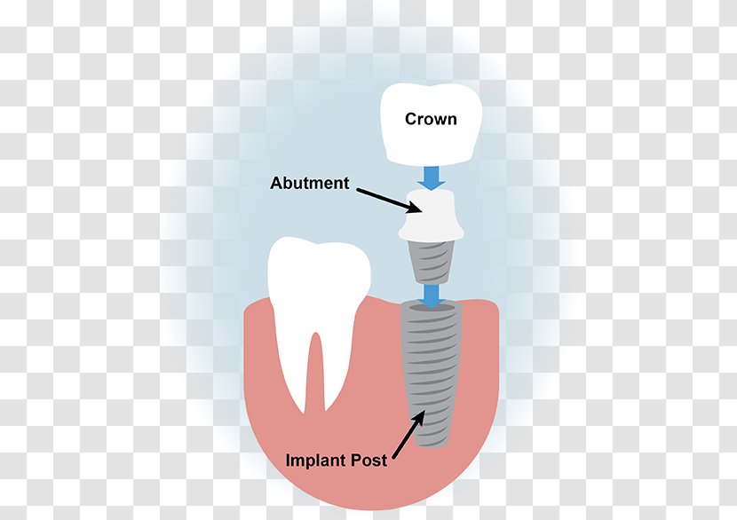 Dental Implant Dentistry Surgery - Cartoon - Implants Transparent PNG