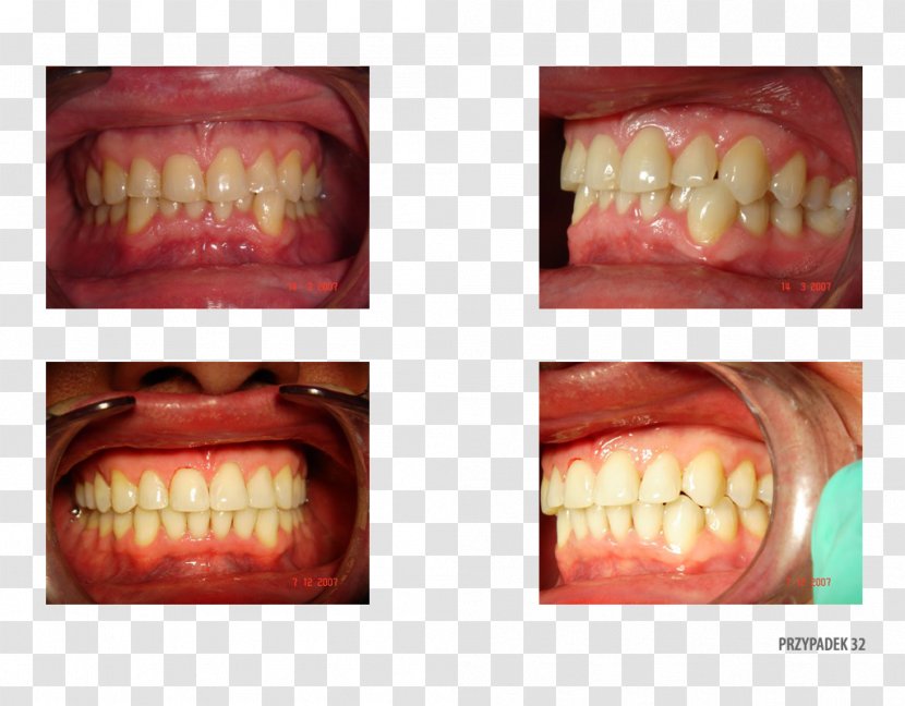 Tooth Close-up Therapy Patient .pl - Lip Transparent PNG