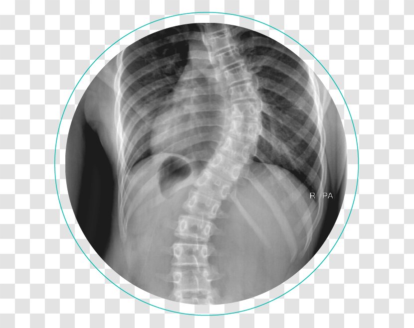 Scoliosis X-ray Vertebral Column Physical Therapy Cobb Angle - Cartoon - Rib Cage Transparent PNG