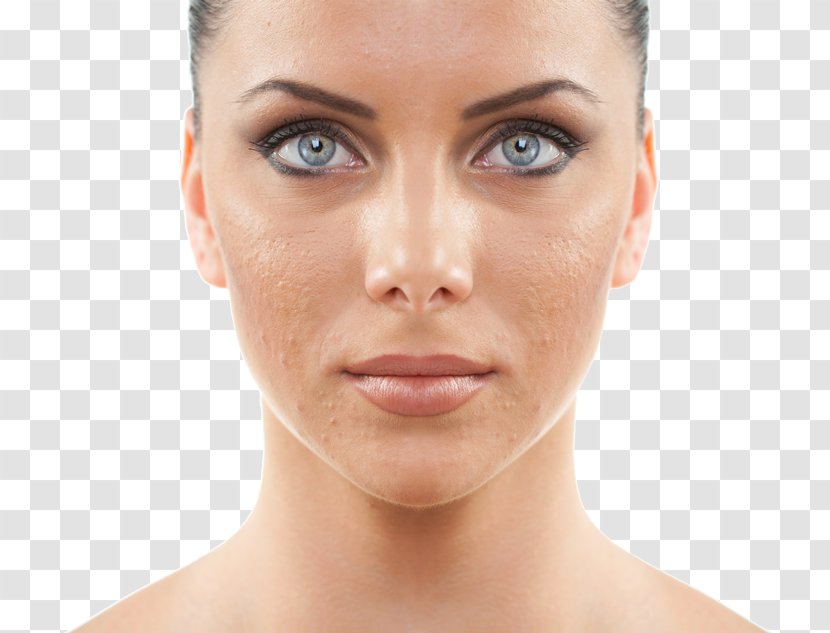 Chemical Peel Exfoliation Facial Skin Photorejuvenation - Chin - Acne Transparent PNG