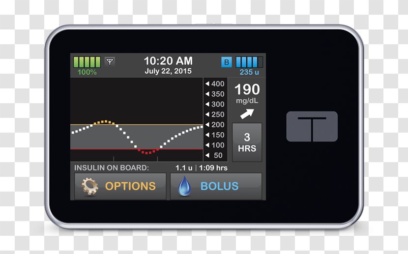 Insulin Pump Tandem Diabetes Care Food And Drug Administration Mellitus - Nasdaqtndm - Artificial Pancreas Transparent PNG