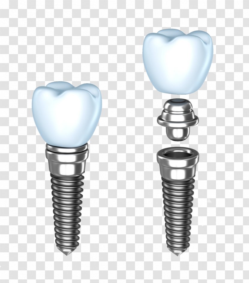 Dental Implant Dentistry Dentures Human Tooth - Oral Hygiene - Implants Transparent PNG