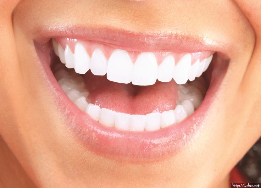 Cosmetic Dentistry Veneer Dental Restoration Makeover - Jaw - Teeth Transparent PNG