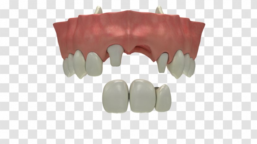 Tooth Loss Dental Implant Dentistry Human - Watercolor - Cartoon Transparent PNG