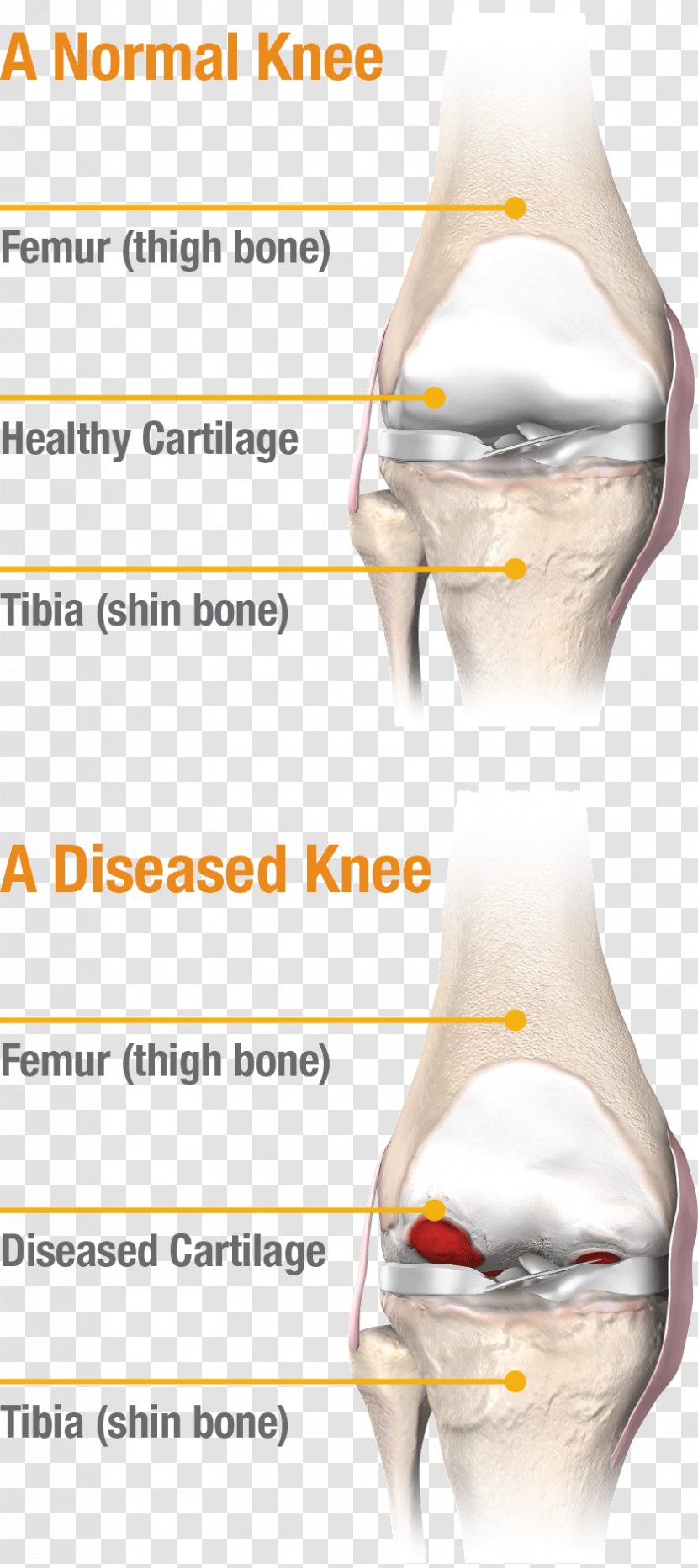 Knee Pain Joint Meniscus Replacement - Cartoon - Frame Transparent PNG