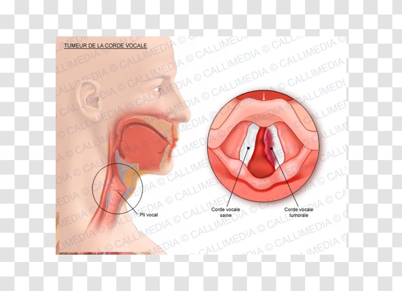 Vocal Folds Cancer Human Anatomy Vowel - Cartoon - CORDE Transparent PNG