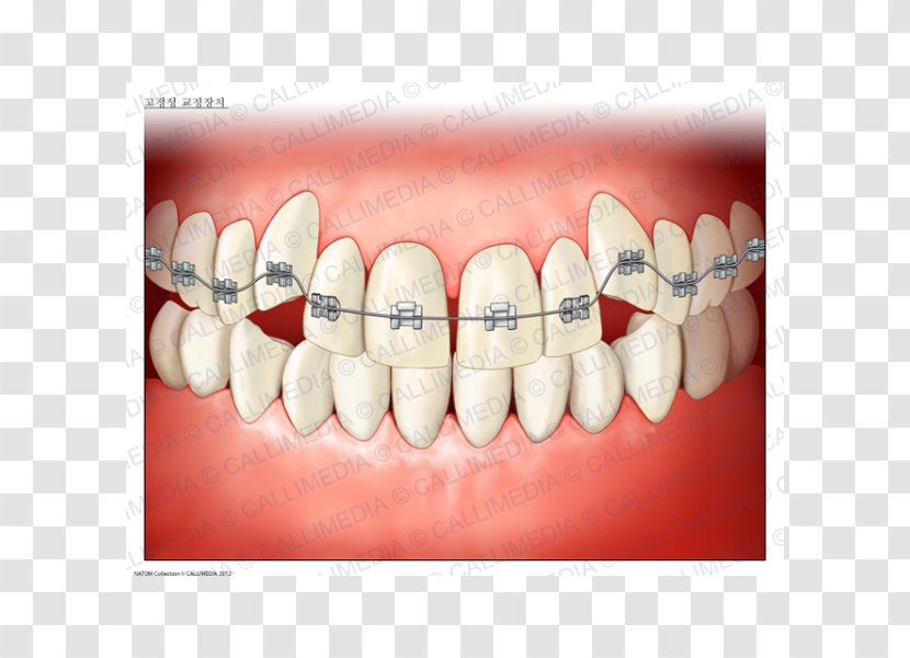 Tooth Dentistry Dental Braces Orthodontics Medicine - Cartoon - Watercolor Transparent PNG