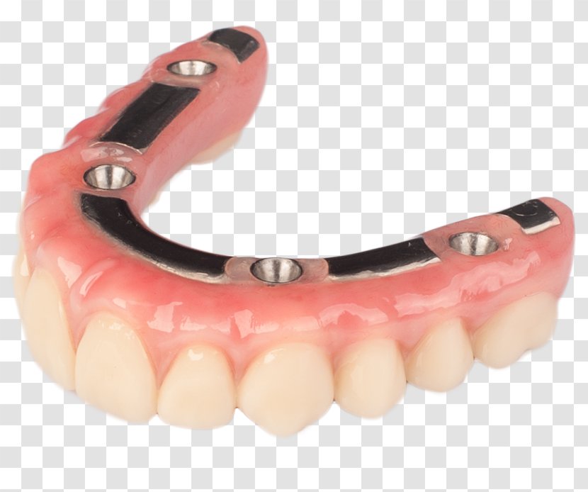 Tooth Dentures Dental Implant Prosthesis - Titanium - Bridge Transparent PNG