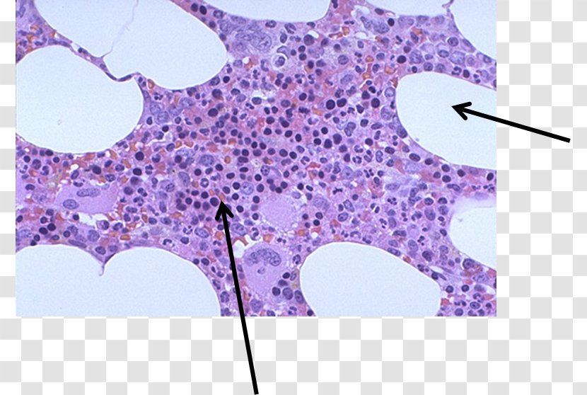 Aplastic Anemia Bone Marrow Failure Examination - Blood Cell Transparent PNG