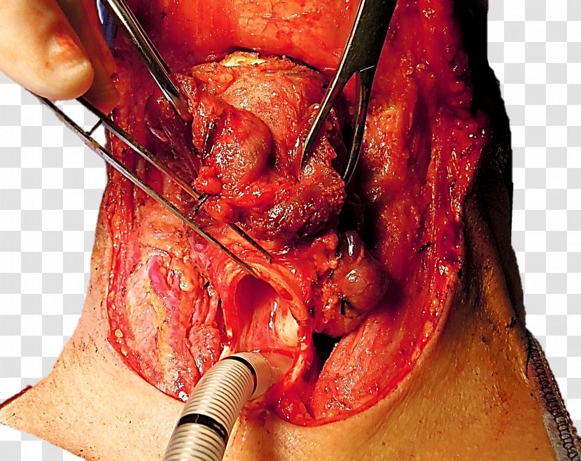 Laryngectomy Trachea Stoma Tracheotomy Glottis - Heart Transparent PNG