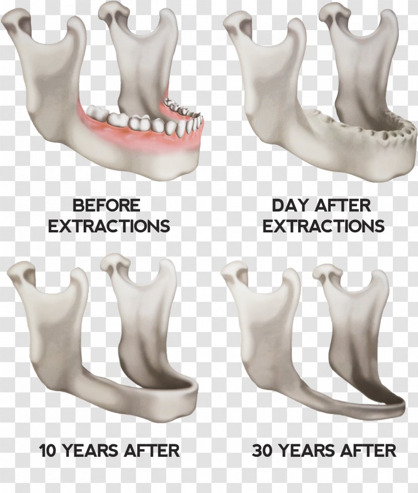 Dentures Jaw Dental Implant Tooth - Prosthesis - Bone Transparent PNG