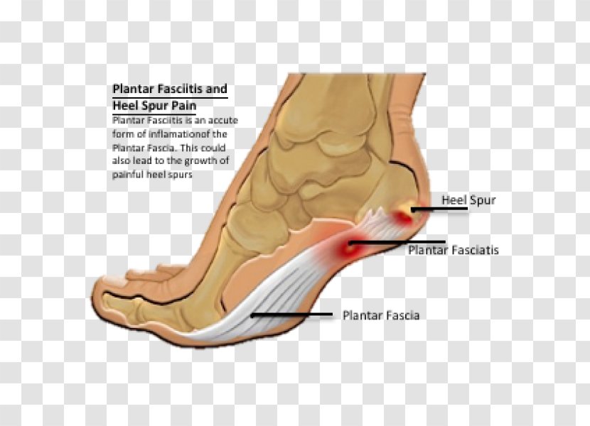 Heel Pain Calcaneal Spur Plantar Fasciitis Foot - Silhouette Transparent PNG