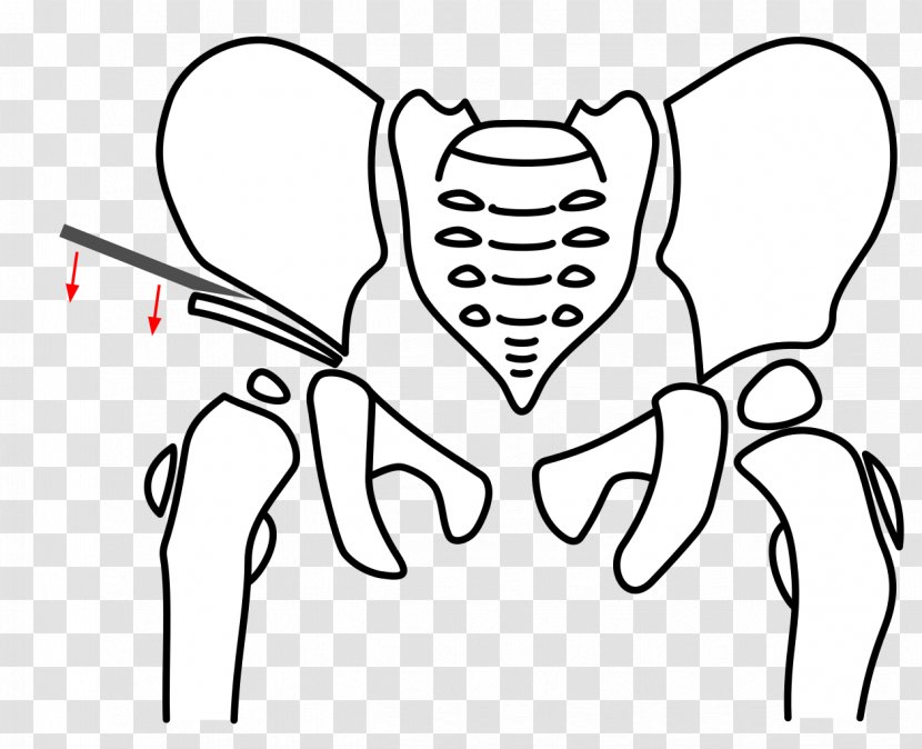 Osteotomy Pelvis Triple-Osteotomie Hip Dysplasia Acetabulum - Silhouette - Pelvic Transparent PNG
