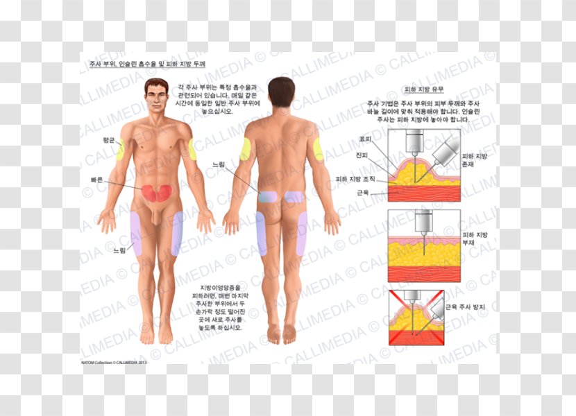 Insulin Subcutaneous Injection Dermatology Skin - Tree - Apparatus Transparent PNG