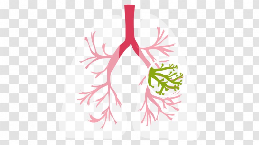 Cystic Fibrosis Lung Medical Diagnosis Symptom Solitary Pulmonary Nodule - Therapy - Lungs Transparent PNG