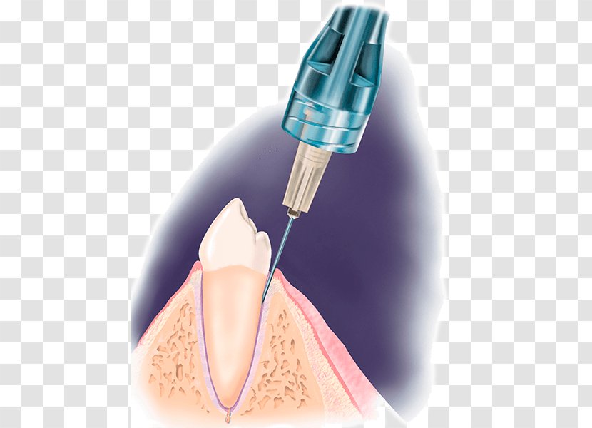 Dentistry Local Anesthesia Dental Anesthetic - Syringe Transparent PNG
