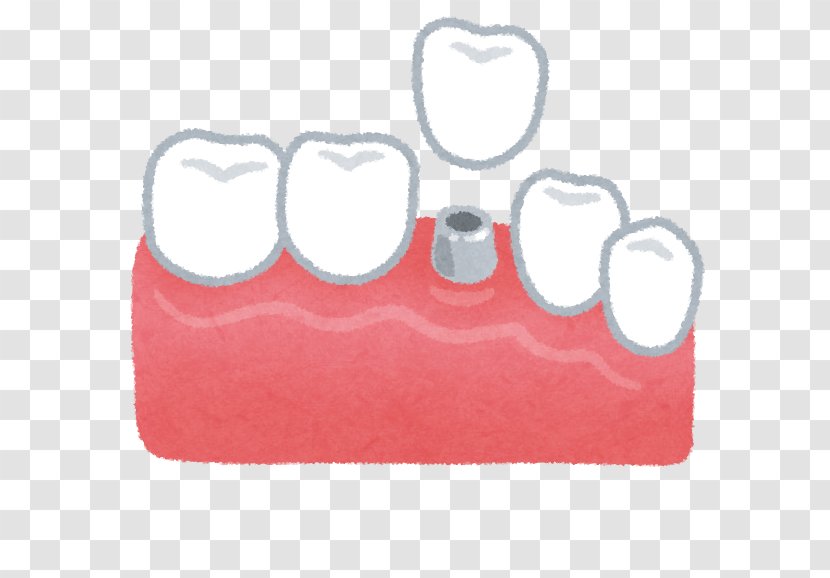 Dentist Dental Implant Therapy Dentures - Periodontal Disease - Tooth Transparent PNG