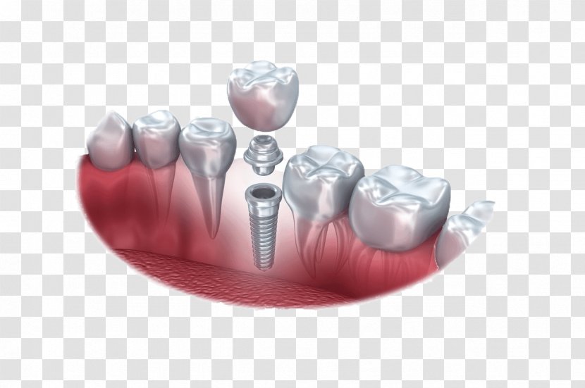Dental Implant Dentistry Tooth - Surgery - Anatomy Of Teeth Transparent PNG