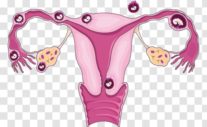 Ectopic Pregnancy Uterus Tubal Ligation Ultrasonography - Flower - Cartoon Transparent PNG