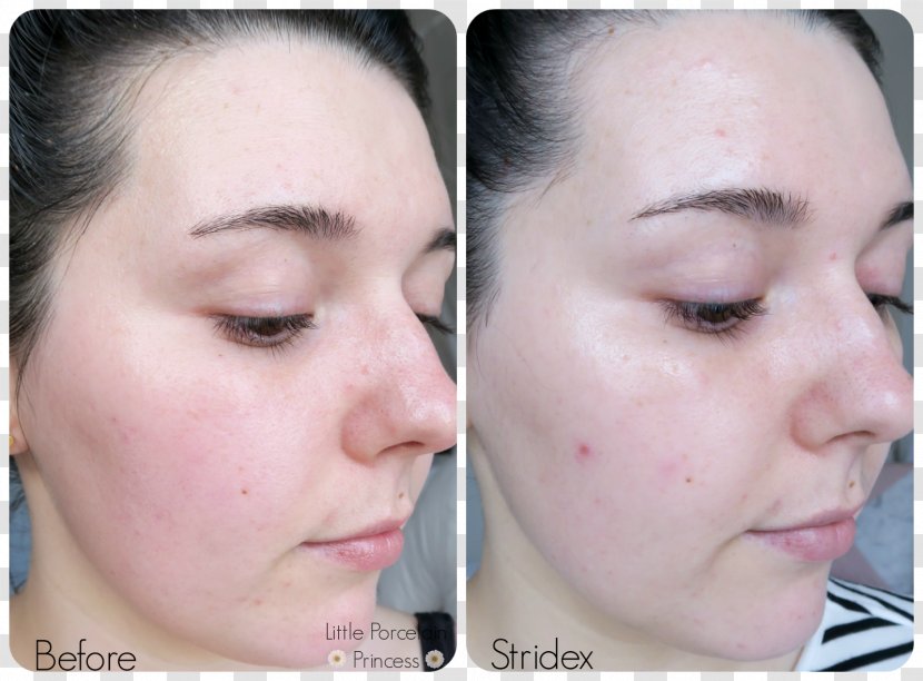 Stridex Maximum Acne Face Skin - Xeroderma Transparent PNG