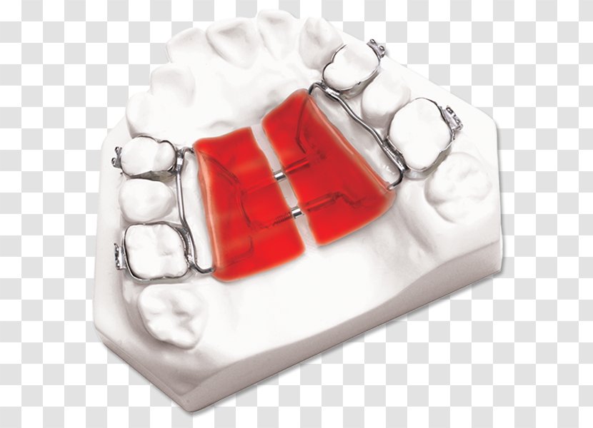 DynaFlex Palatal Expansion Orthodontics Orthodontic Technology Maxilla Transparent PNG
