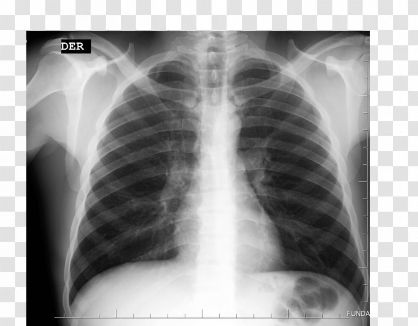 X-ray Radiology Radiography Rib Medical Imaging - Frame - Ylang Transparent PNG
