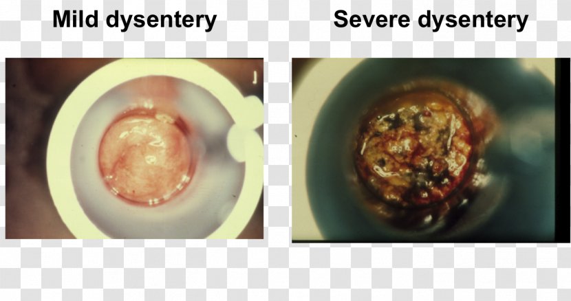 Human Feces Dysentery Diarrhea Blood In Stool Test - Mucus Transparent PNG