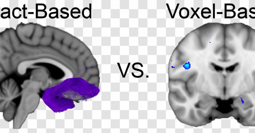 Diffusion MRI Brain Voxel-based Morphometry Magnetic Resonance Imaging White Matter - Flower Transparent PNG