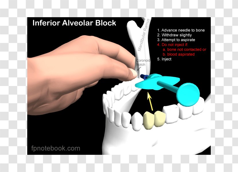 Inferior Alveolar Nerve Anaesthesia Posterior Superior Mandibular Block - Syringe Needle Transparent PNG