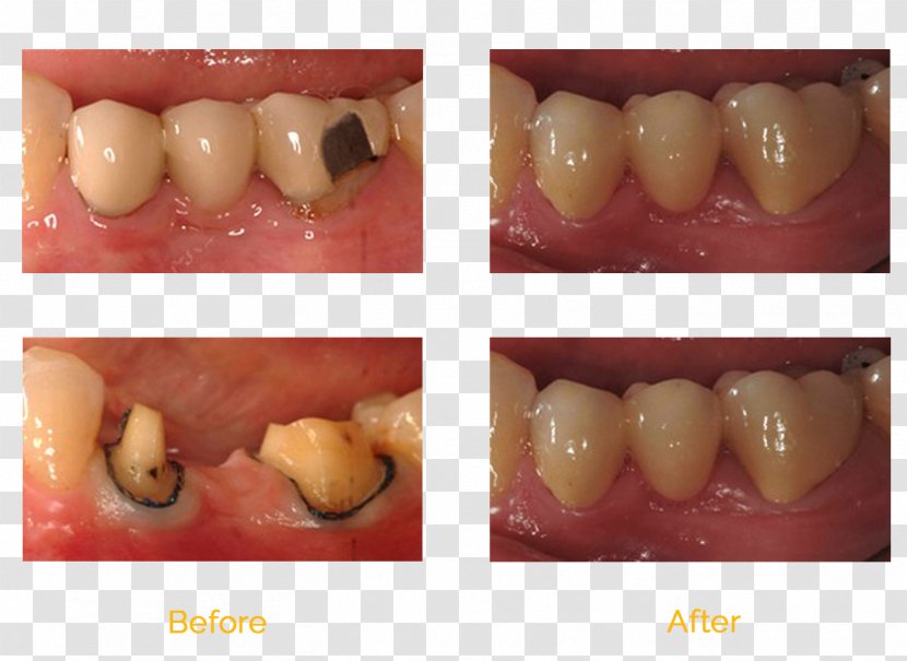 Tooth Bridge Molar Dentistry Dental Implant Transparent PNG