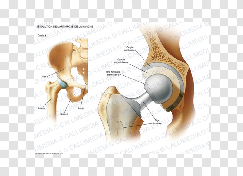 Hip Osteoarthritis Prosthesis Rheumatoid Arthritis - Silhouette - Ráº¯n 3d Transparent PNG