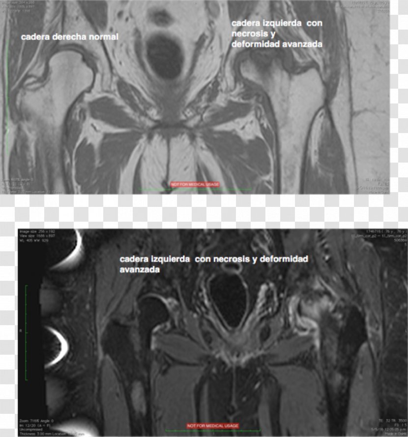 Bone Infarction Computed Tomography Femoral Head Femur Legg–Calvé–Perthes Disease - Radiology - Vascular Transparent PNG