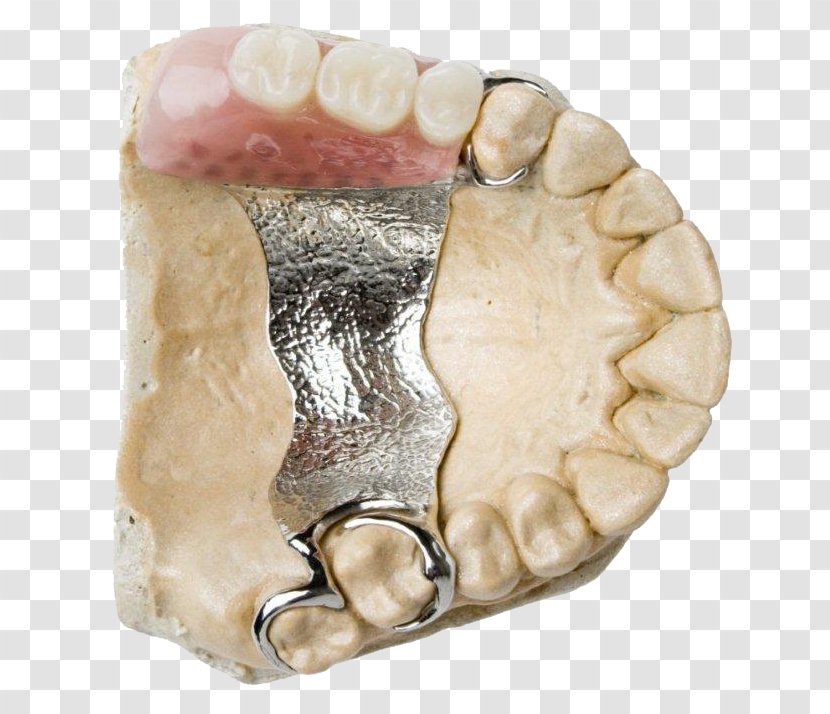 Dental Prosthesis Dentistry Dentures Prosthodontics - Implant - Scaling And Root Planing Transparent PNG