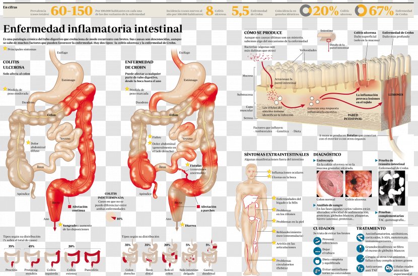 Inflammatory Bowel Disease Crohn's Ulcerative Colitis Intestine - Tree - Crohns Transparent PNG