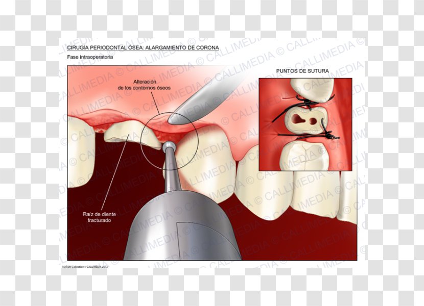 Crown Lengthening Surgery Periodontal Disease Tooth - Laserassisted New Attachment Procedure Transparent PNG