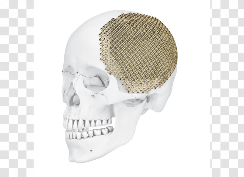 Skull Implant Surgical Mesh Surgery Transparent PNG