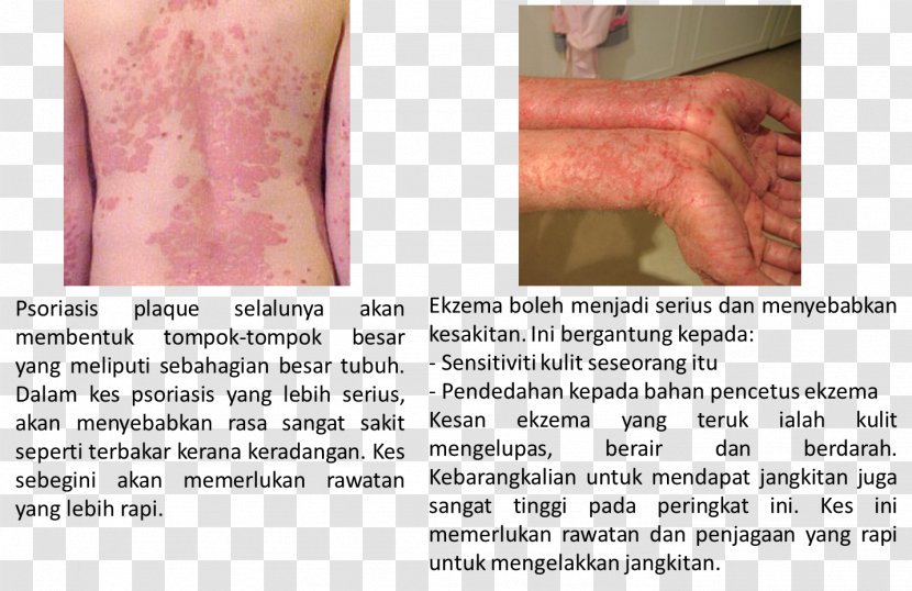 Thumb Cell Psoriasis Skin Eczema - Silhouette - Gandum Transparent PNG