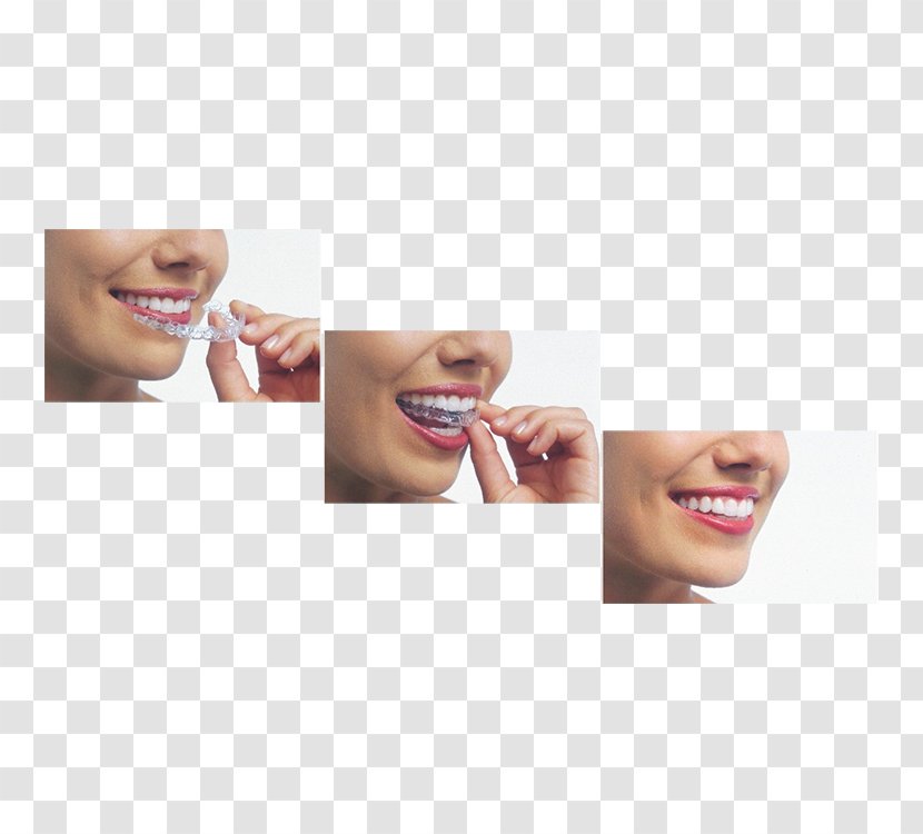 Clear Aligners Dental Braces Orthodontics Dentistry - Smile - Teath Transparent PNG