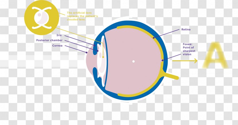 Cataract Surgery Intraocular Lens Merck Group - Visual Perception - Brand Transparent PNG