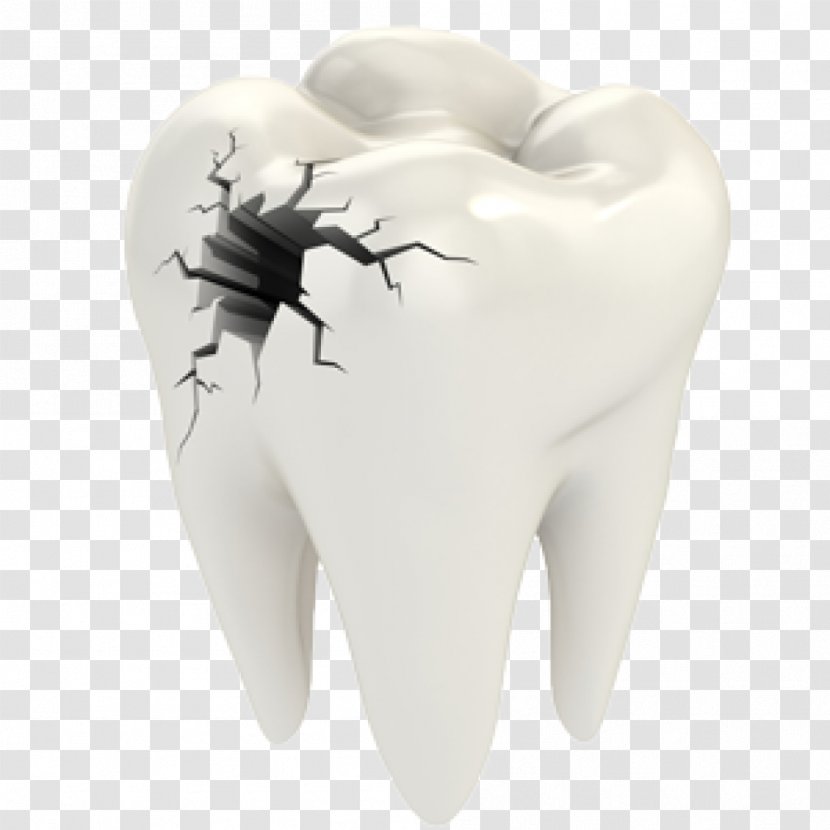 Cracked Tooth Syndrome Dentistry Dental Restoration Human - Cartoon - Teeth Transparent PNG