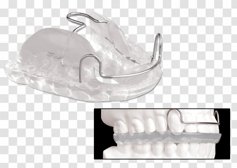 Jaw Mandible Splint Dentistry Maxilla - Mandibular Advancement Splints Transparent PNG