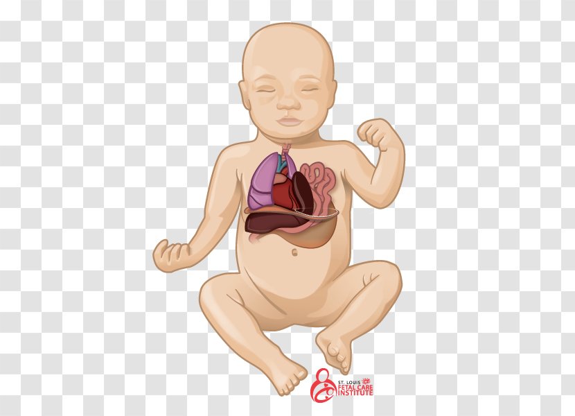 Pulmonary Hypoplasia Congenital Airway Malformation Diaphragmatic Hernia Lung - Tree - Watercolor Transparent PNG