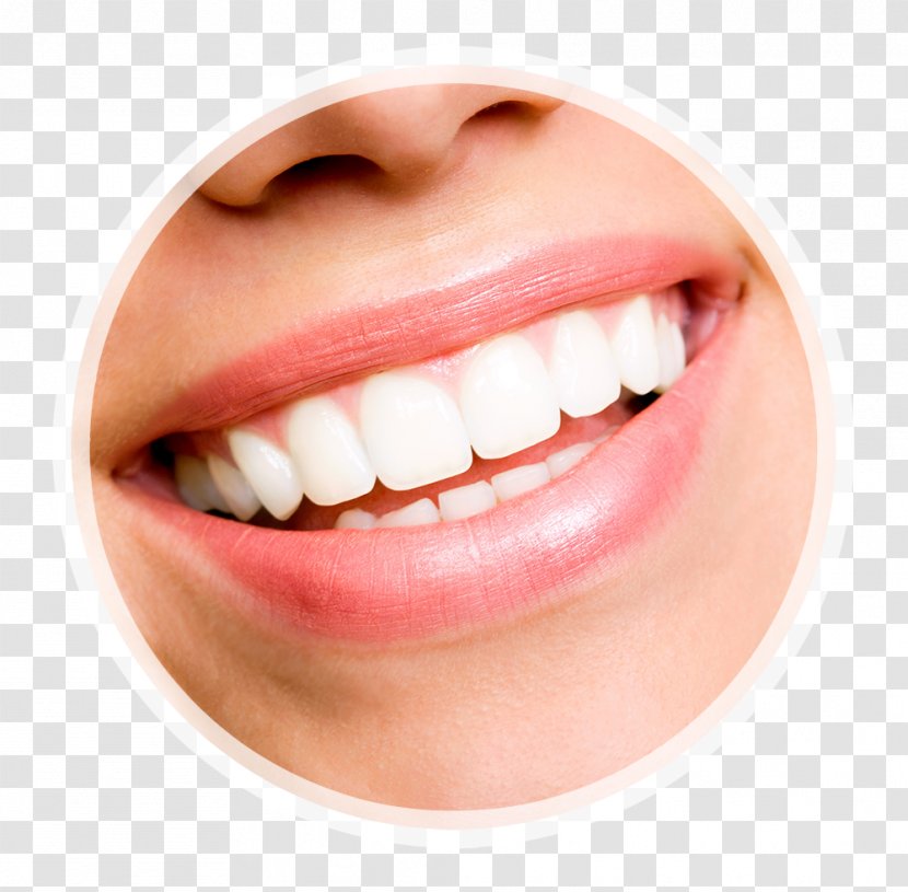 Veneer Tooth Whitening Human Dentistry - Smile - Coffee Stains Teeth Transparent PNG